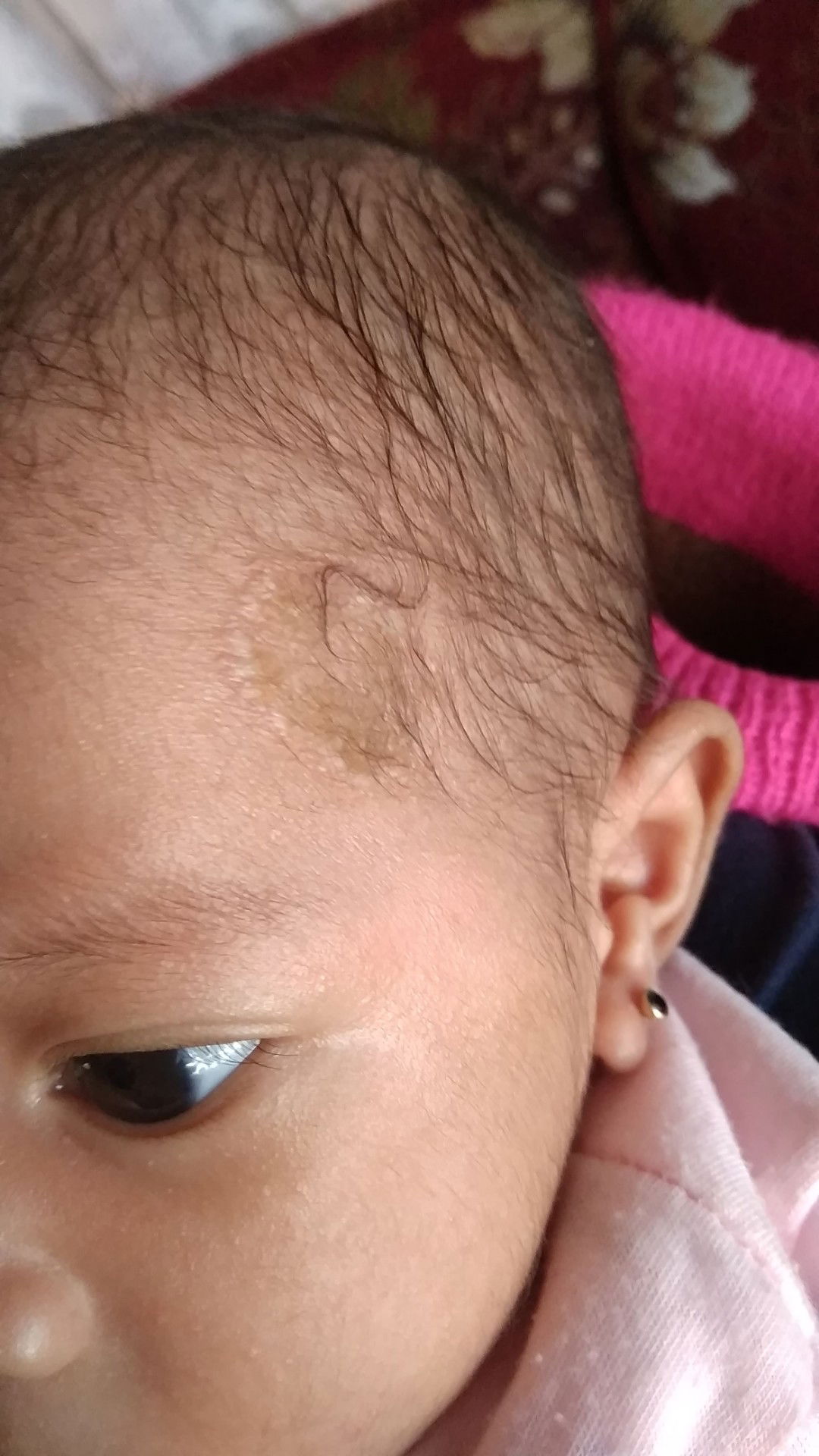 bintik bintik bernanah d jidat bayi