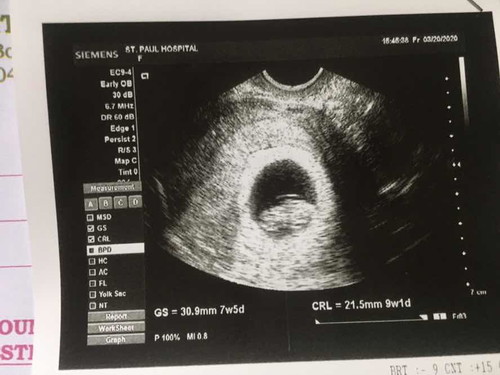 8 weeks preggy, and I'm diagnosed with a heart disease