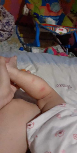 Rashes