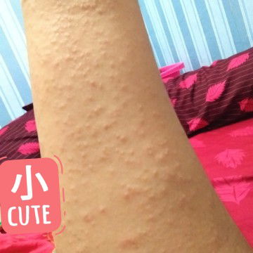 bruntusan + gatal selama hamil