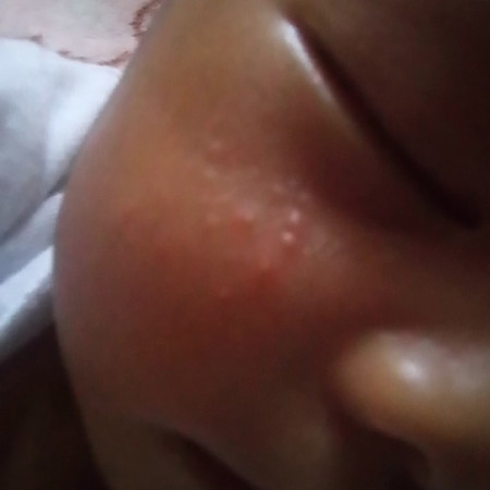 face rashes