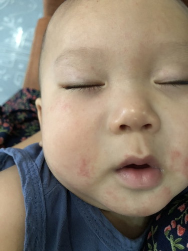 ผื่นบนใบหน้าของลูกน้อย