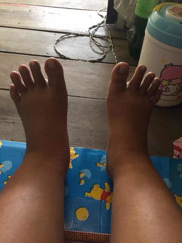 เท้าบวม