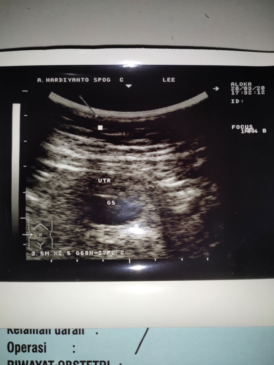 blm kelihatan janin dan djj nya