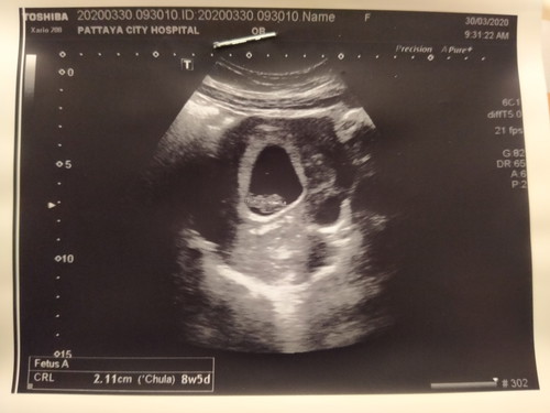 ท้องเล็ก