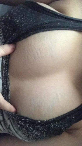 Stretch mark