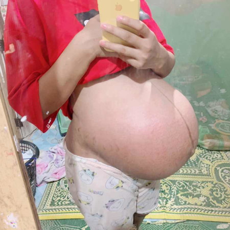 อยากแตกแล้วท้องลดมากไม่มีวี่แววเลย 37w แฝด ญ