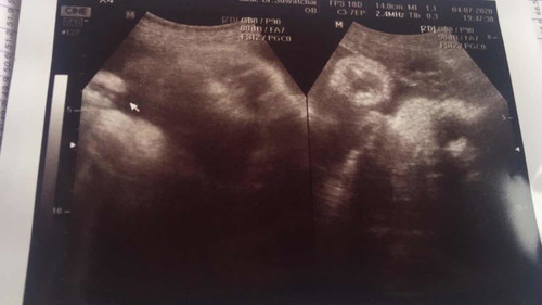 37w6d หญิงแน่นอนจ้า