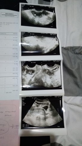 keguguran dan promil lagi