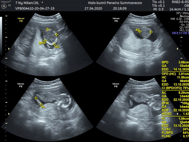 Hasil usg 2d dan 4d usia 14 minggu