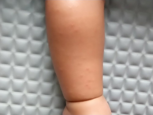 bintik merah ditangan