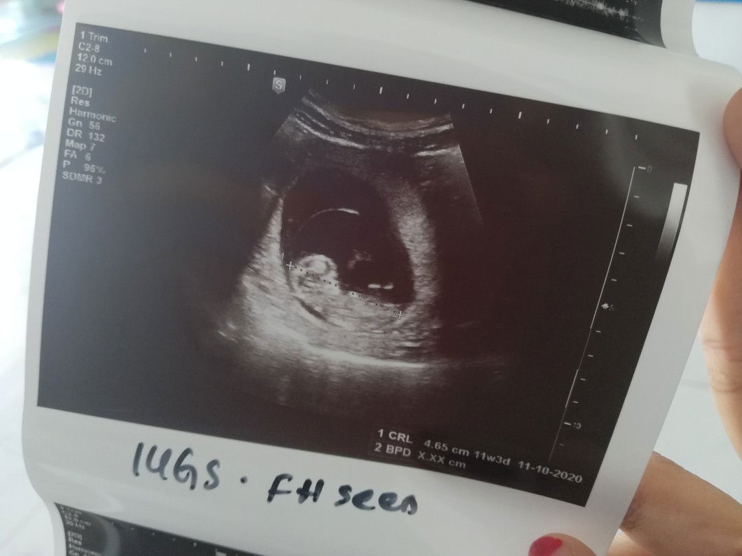 InsyaAllah, ada rzki dapat TWIN...