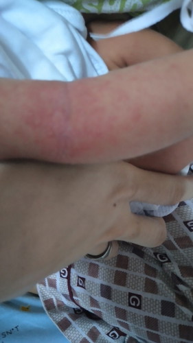 rashes for baby..1 week old lang po si lo