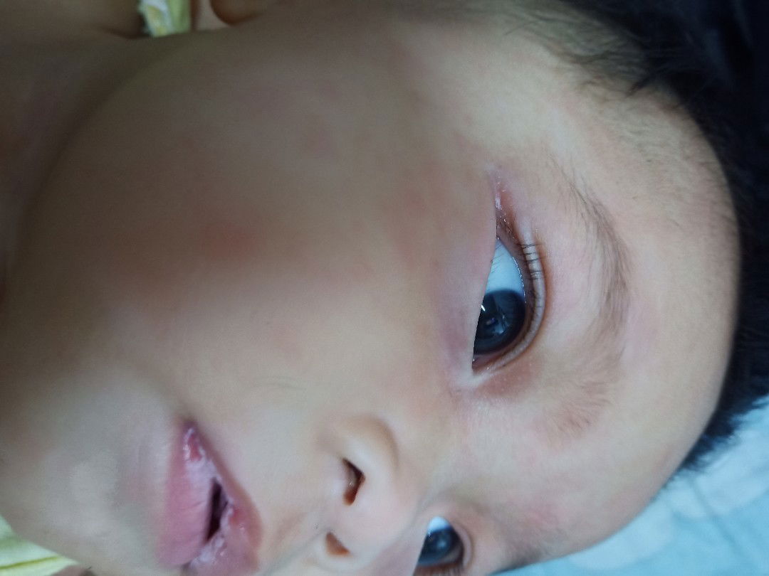 ลูกเปนร้อนใน