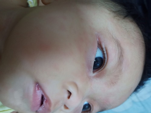 ลูกเปนร้อนใน