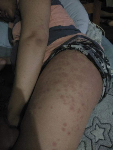 PUPPP - Pruritic urticarial papules and plaques of pregnancy