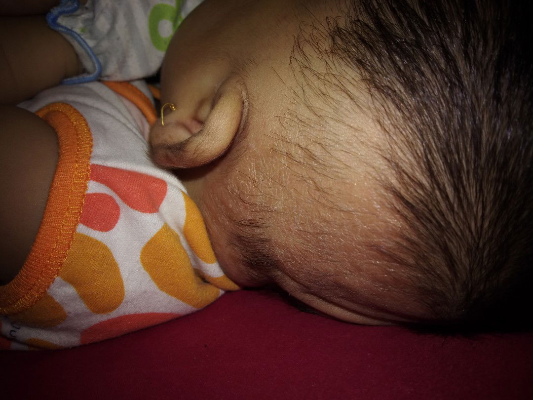 mengkerut pada kulit bayi