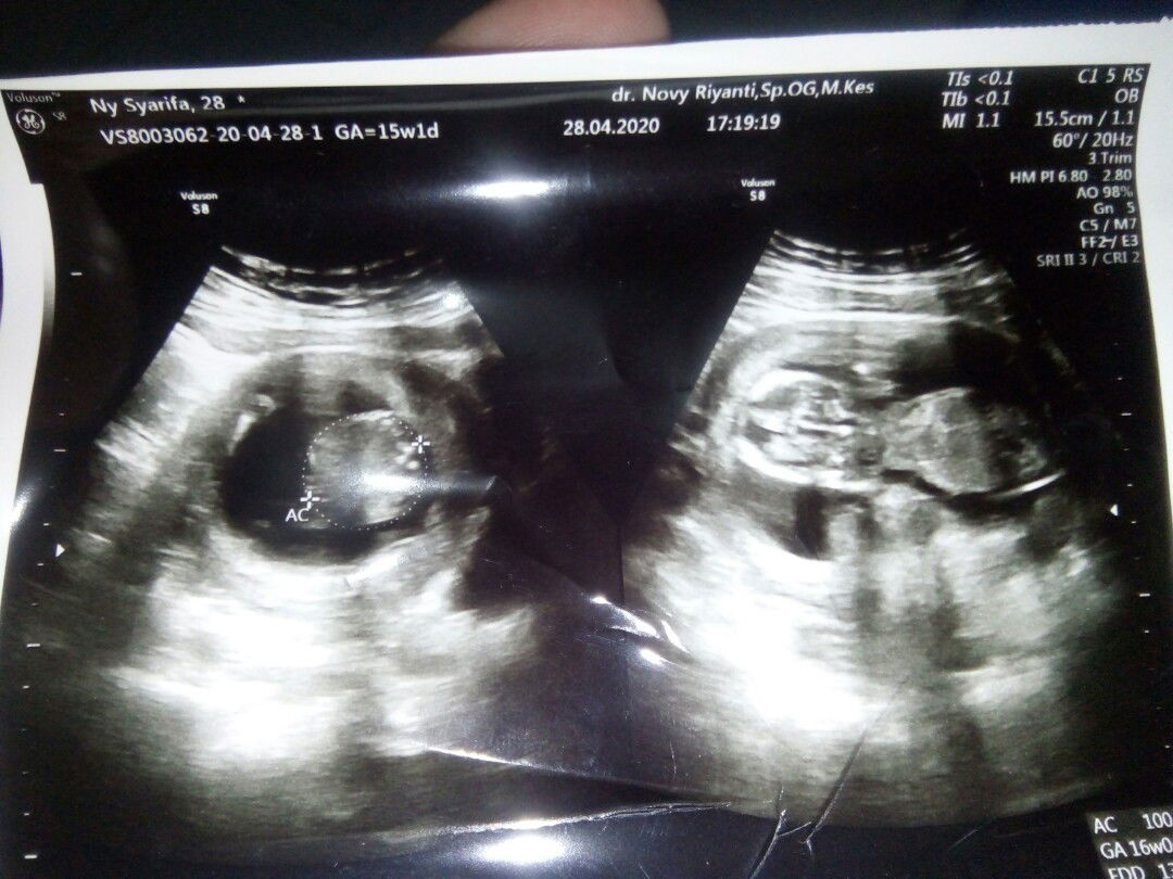 Sedang Hamil