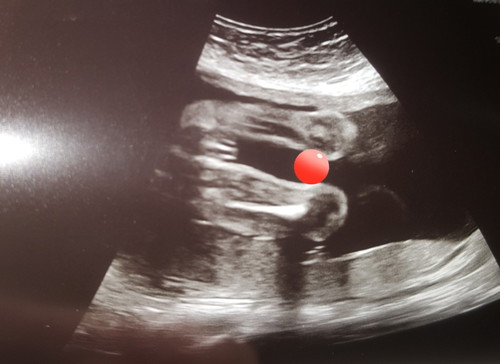 baby gender