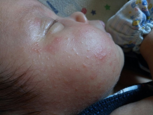 ลูกแพ้แป้ง