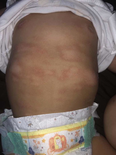 Perut anakq dan tangannya seperti ini.. apakah ada yg seperti ini.. di beri apa ya?