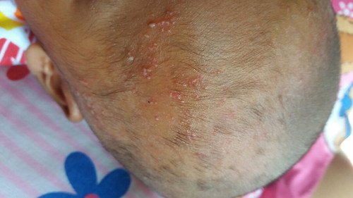 ada yg tau knp dan obat nya?