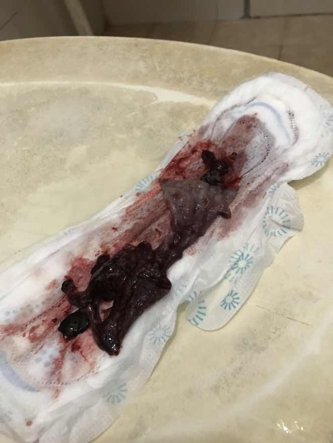 Pendarahan macam haid