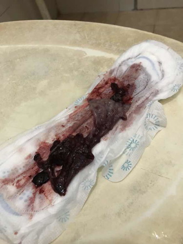 Pendarahan macam haid