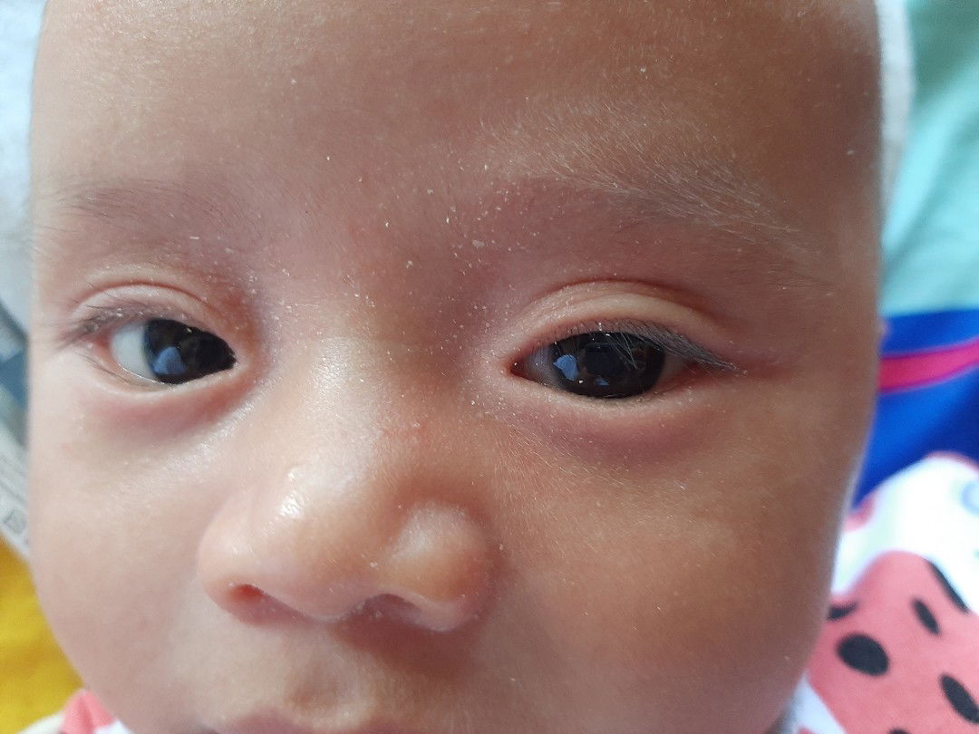 mata seperti berkerak