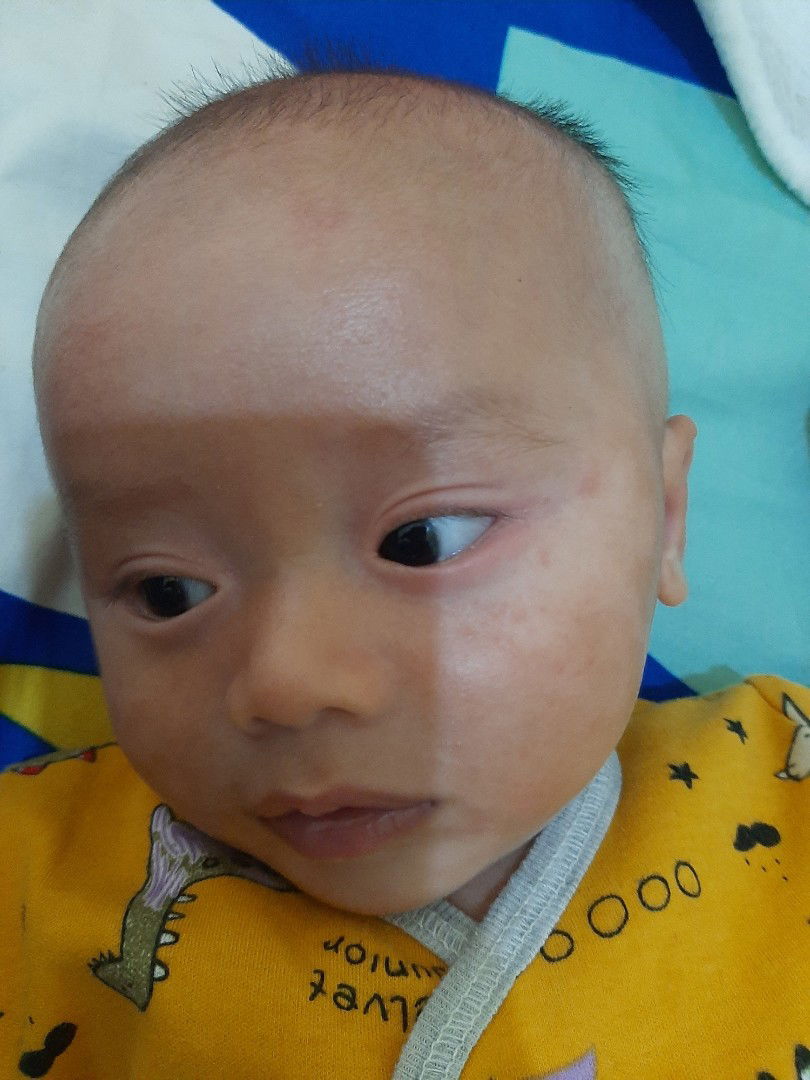 Muka belang pada bayi