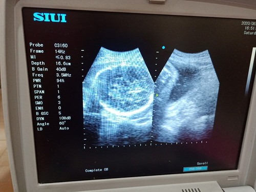 Baby Ultrasound 🥰