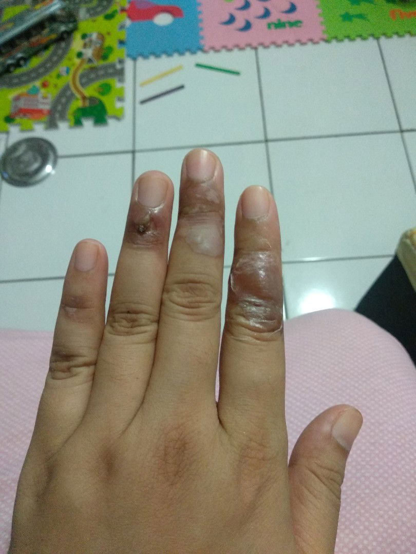 Tangan kesiram minyak panas