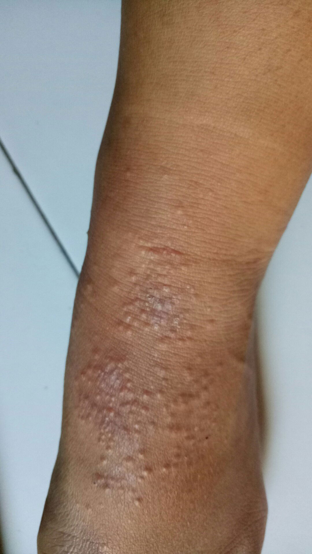 Obat Gatal pada kaki saat hamil