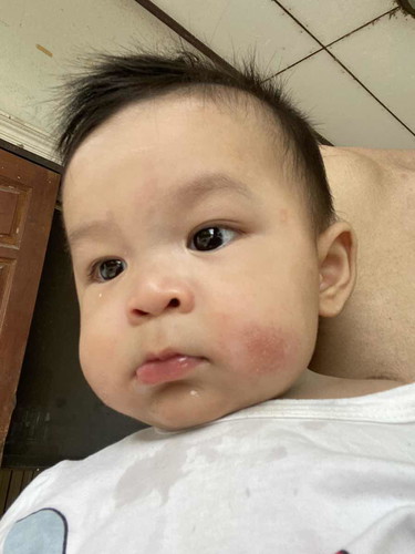 สอบถามแม่ๆที่ลูกเคยมีอาการแพ้ที่บริเวณแก้มครับ