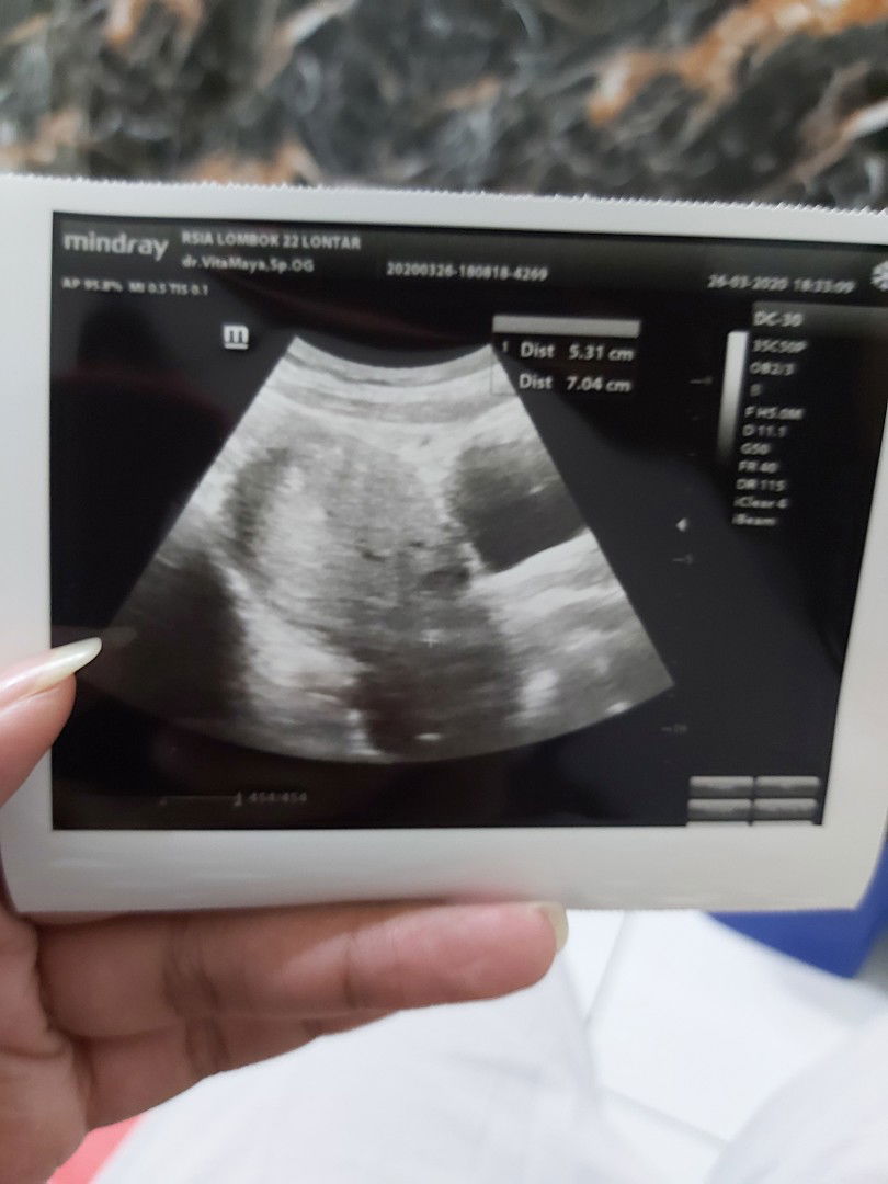 Cara Menghitung Umur Janin (utk moms yg mens nya tdk teratur)