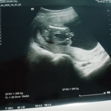 อยากรู้เพศลูก