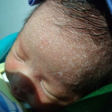 alergi atau biang keringat