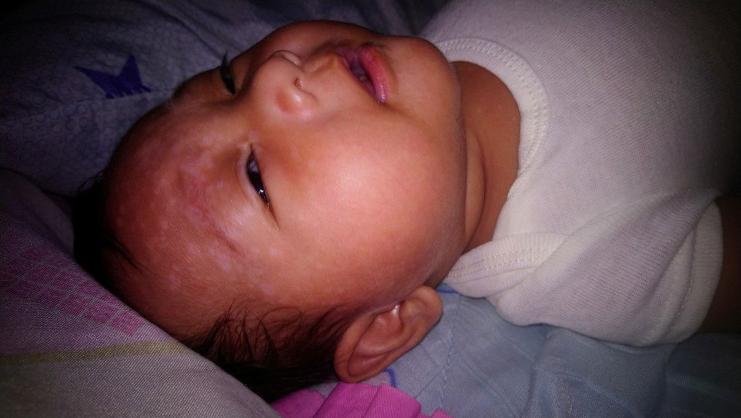White Patches on Baby Face 3 Months Old