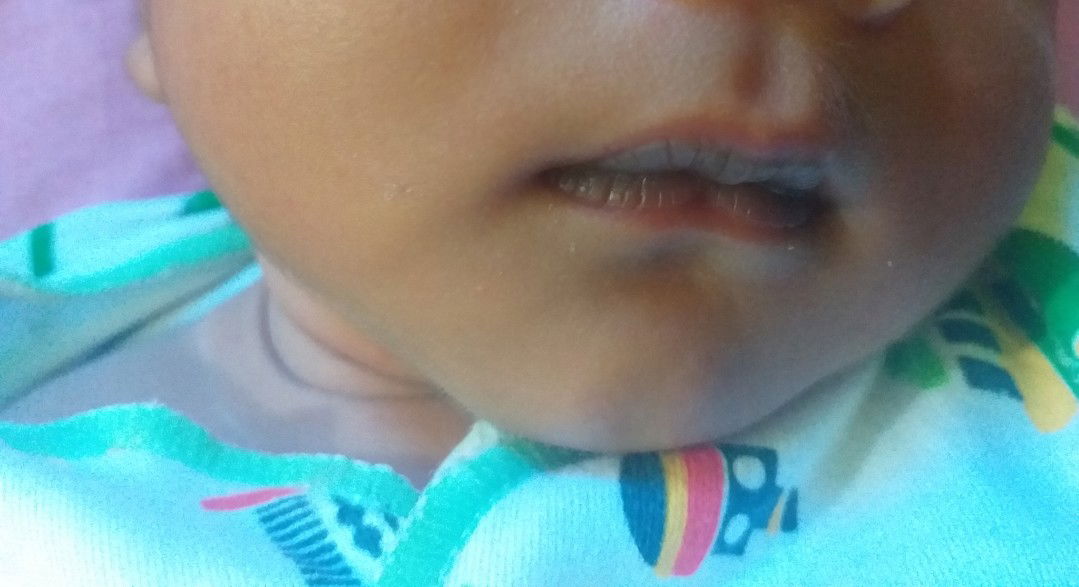 bibir bayi seperti kebiruan