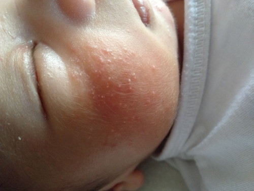 skin rashes
