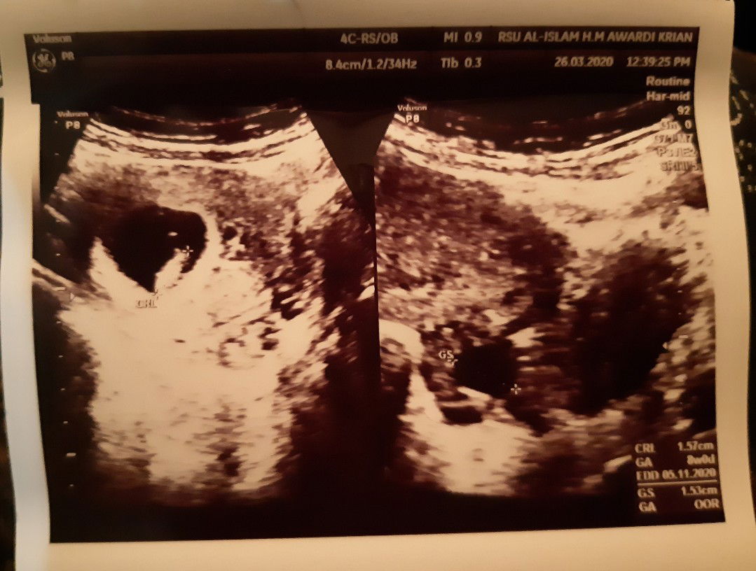 Kehamilan di luar kandungan