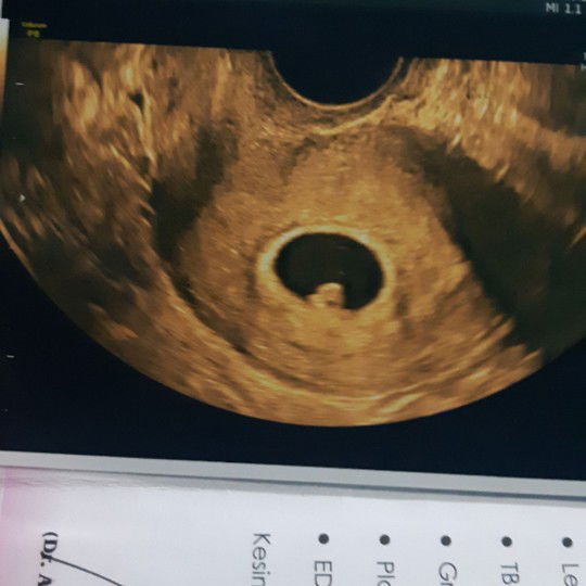 usg pertama UK 7 week