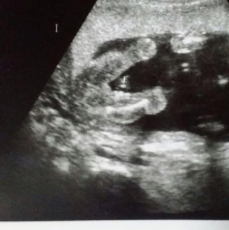 เพศลูก?