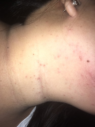 pimples