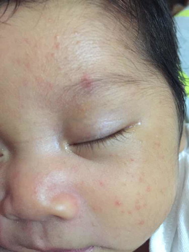Baby face rashes?