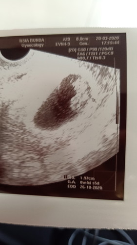 Selamat malam mom, ada yang bisa bantu baca hasil usg ?