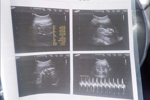 26 w น้ำหนักครรภ์. 938 g