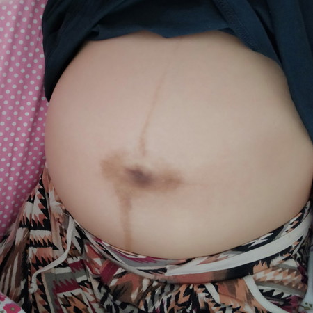 สะดือดำคล้ำ