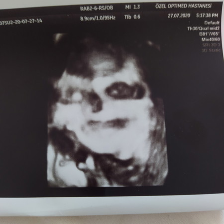 อัลตร้าซาวด์