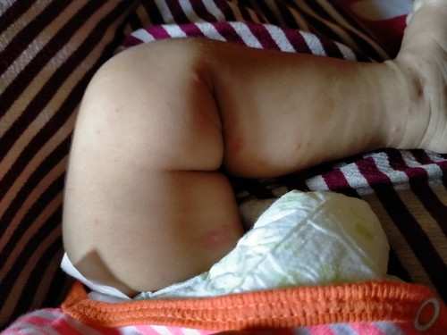 ini knpa y mom bintik bintik di kaki perut sama punggung merah mkin bnyak